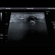 Chronic osteomyelitis and bone squestration: US - Ultrasound